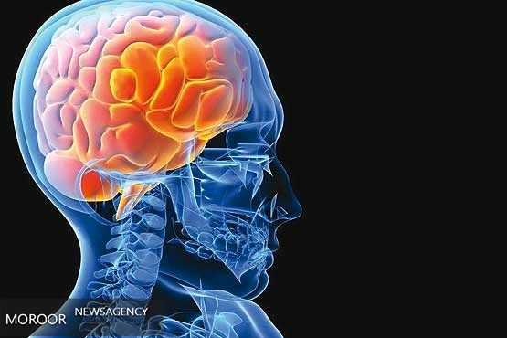 هر 5 دقیقه یک ایرانی سکته مغزی میکند