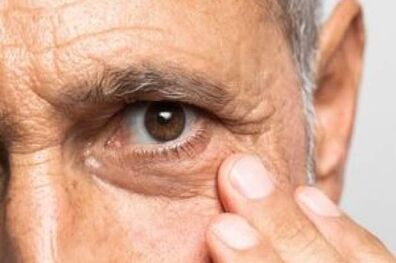 دلیل پف زیر چشم چیست؟
