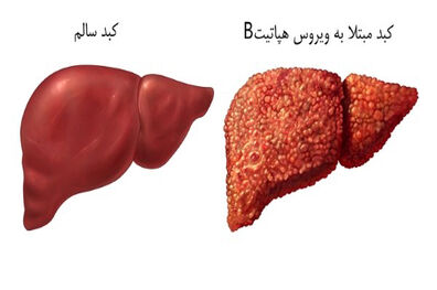 هپاتیت B به مرحله کنترل رسید/ خطر ابتلا در پرسنل پزشکی و پرستاری / بیماران هموفیلی واکسن دریافت می‌کنند