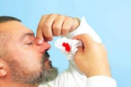 چند توصیه مهم در خصوص خونریزی بینی
