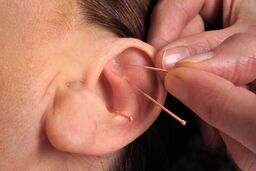 طب سوزنی مشکلات  یائسگی را کمتر می کند