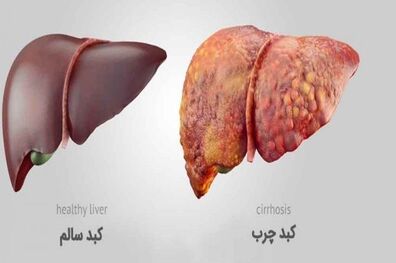 روشی ساده برای داشتن کبدی سالم