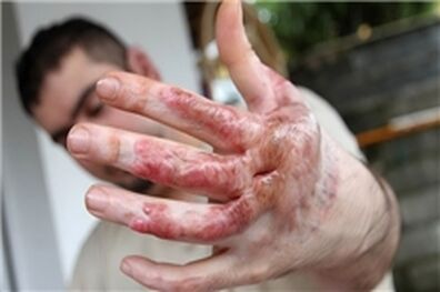 هزینه درمان سوختگی بین 2 تا 5 میلیون تومان/ لباس سوختگی تحت پوشش بیمه قرار گیرد